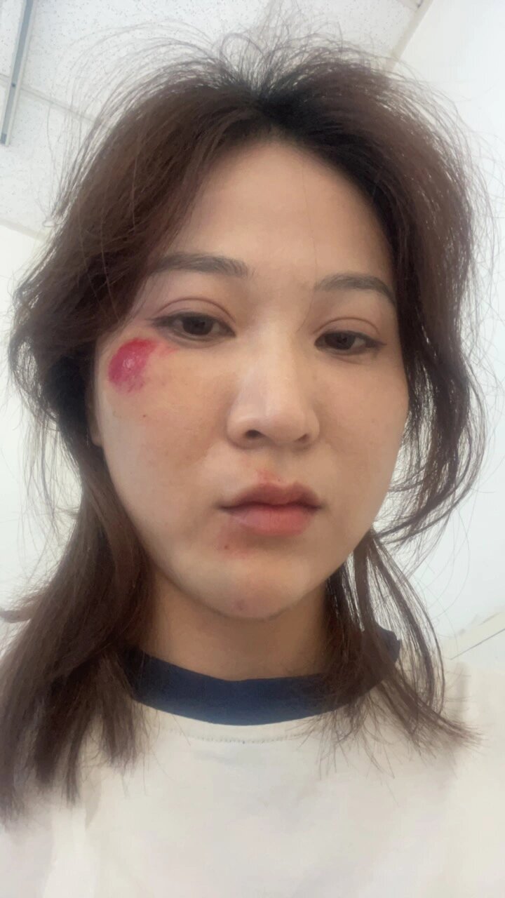 脸擦伤真的会留疤吗?