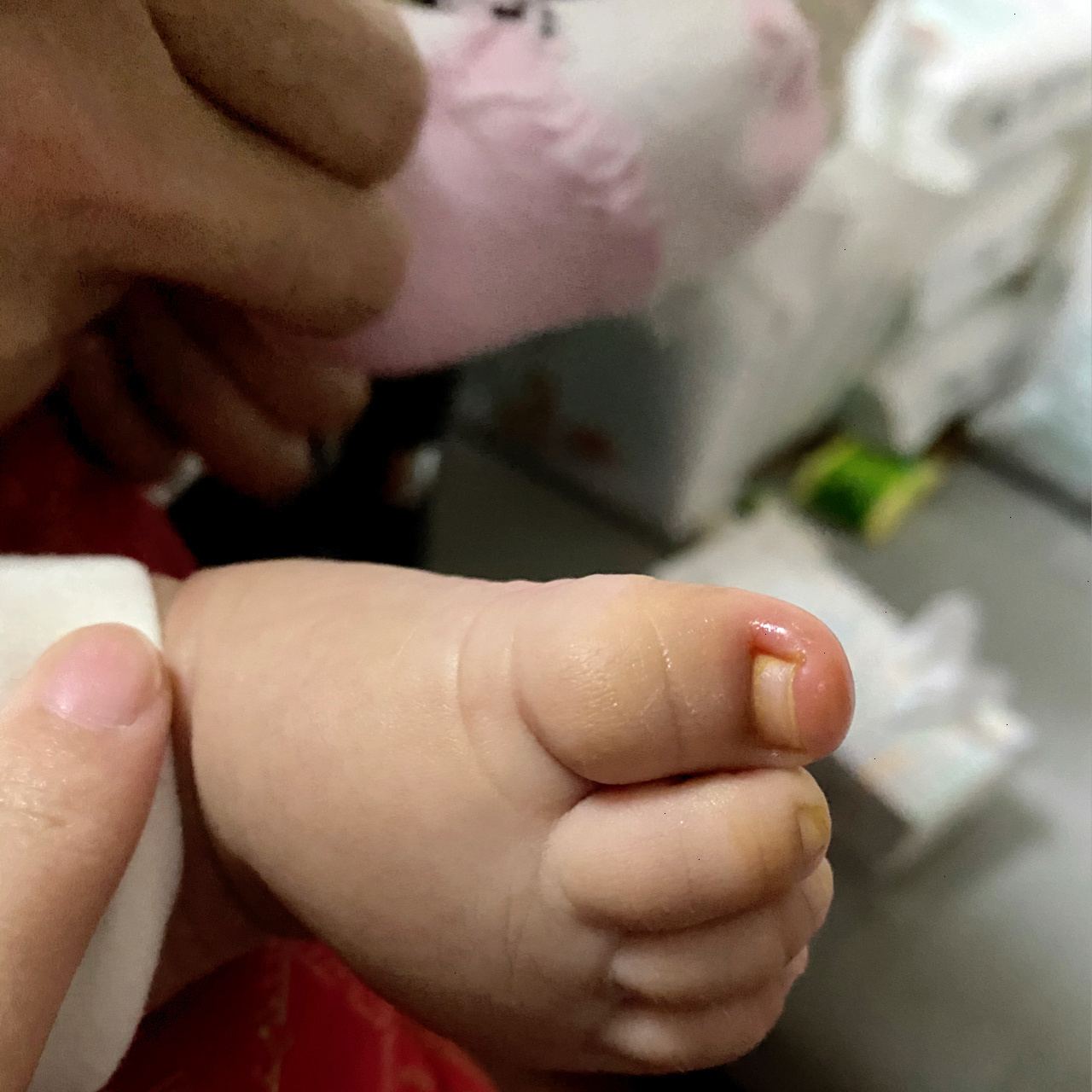 【带娃】记宝宝甲沟炎,亲测有效 宝宝三个多月的时候忽然指甲长进肉里