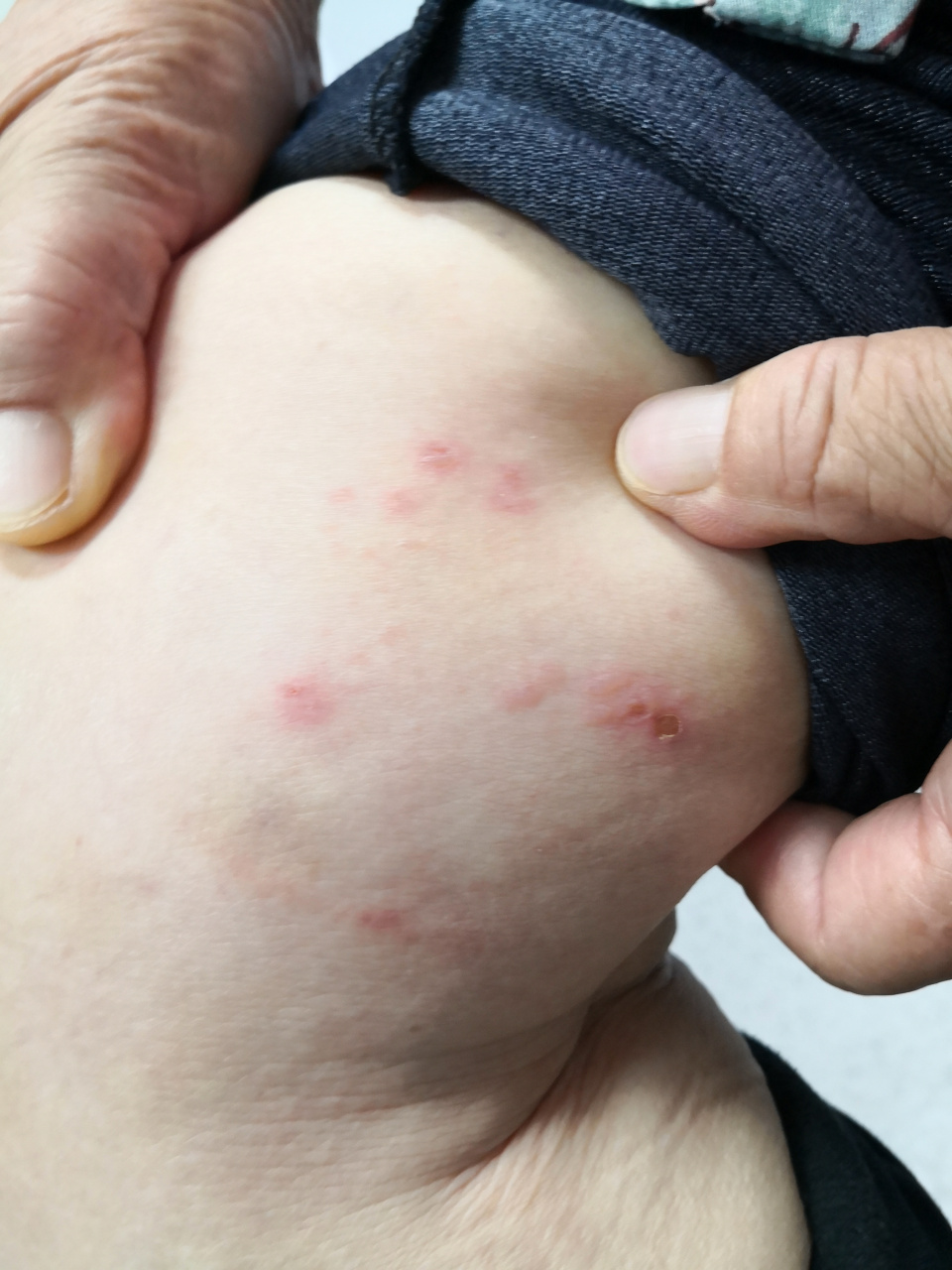 老年女性右侧下肢疼痛症状两周,近来右下肢出现红斑,小疱.考虑带状疱