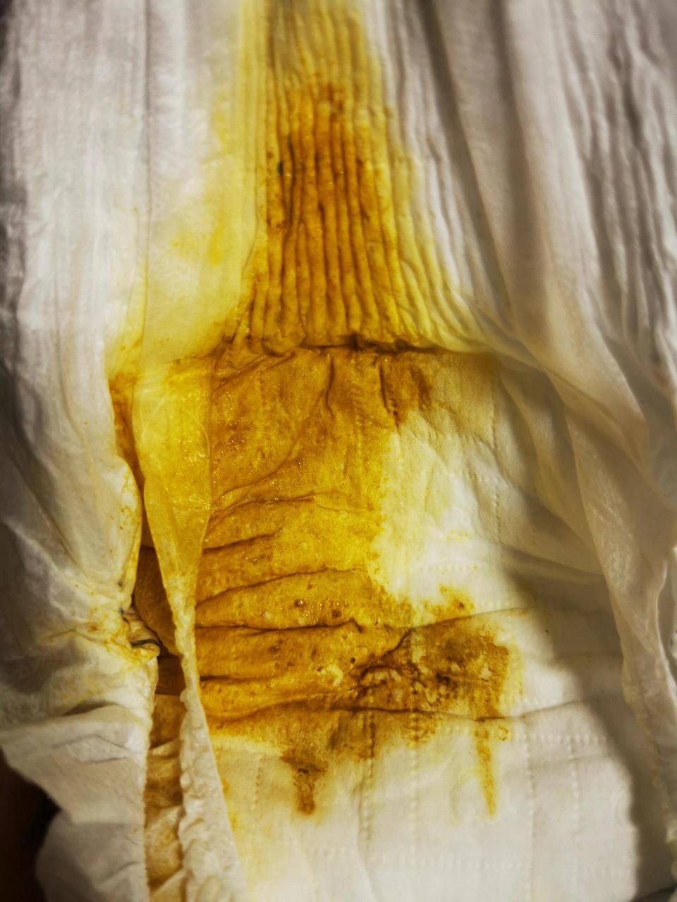 轮状病毒弱阳性 乳糖不耐受怎么办啊 目前3月龄 从9月份开始到现在