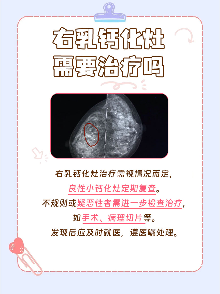 乳腺点状钙化图片