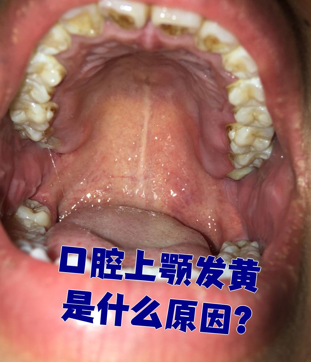 口腔上颚发黄常见原因包括饮食不良,长期吸烟和口腔炎症