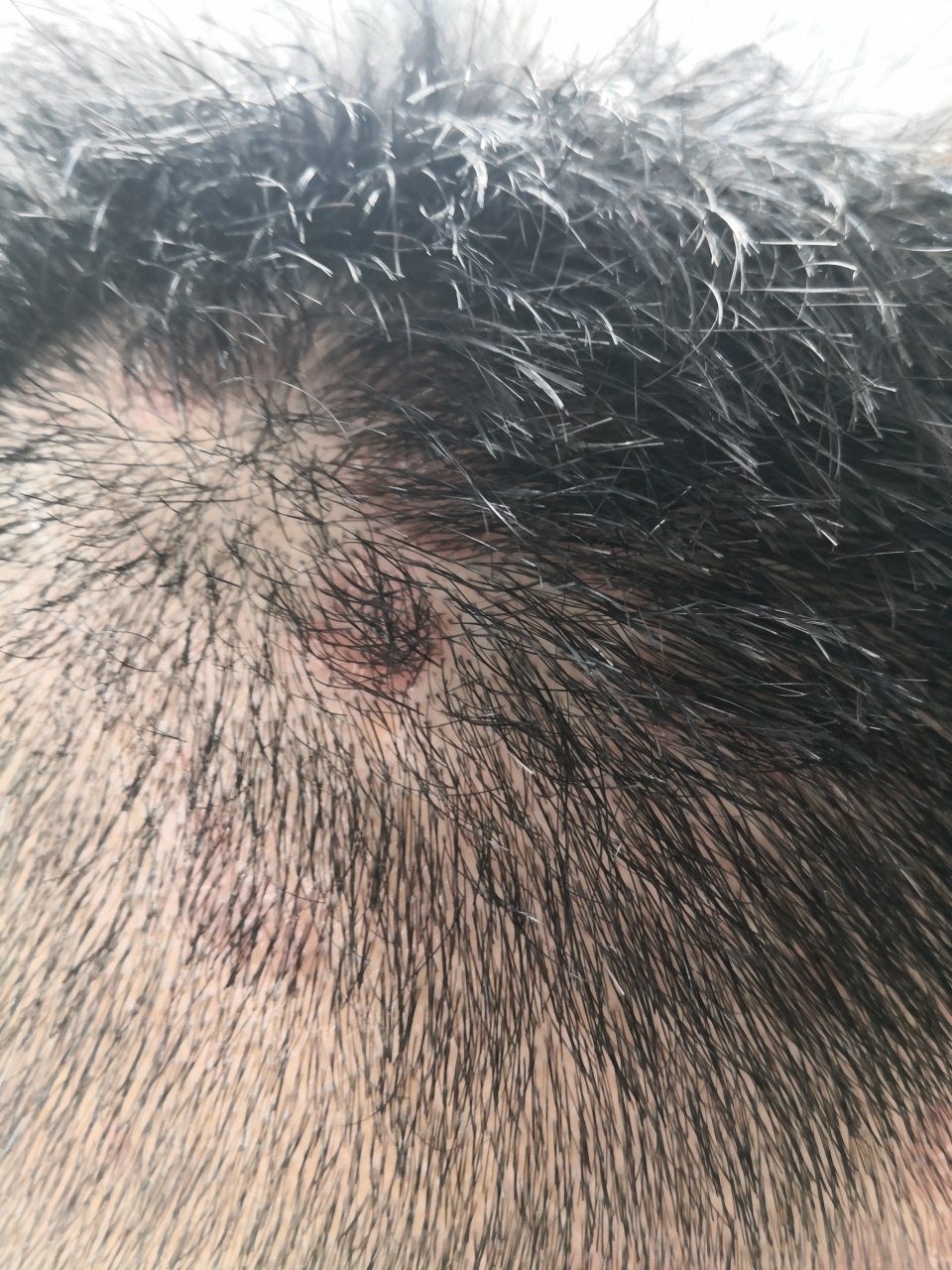 头皮鳞屑性斑块症状.四肢散发点状红斑.