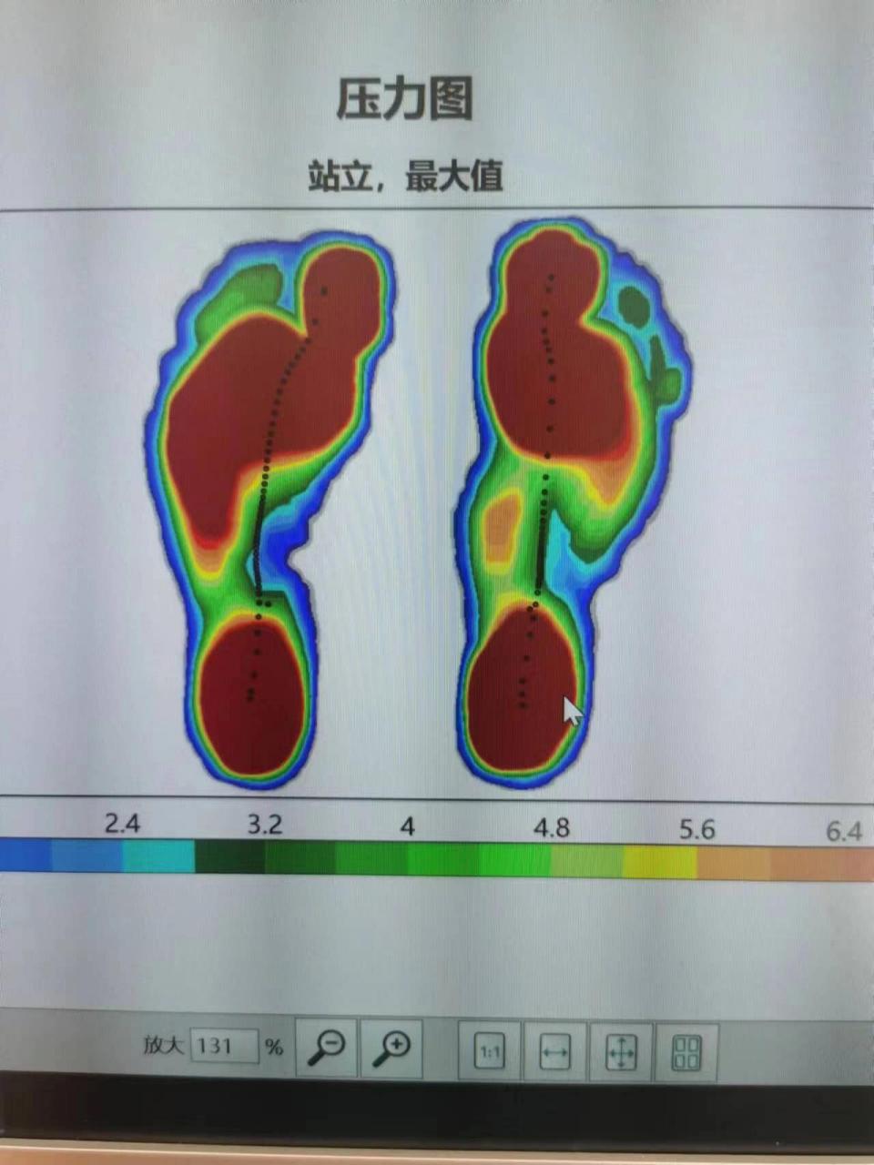 看到这种足底受力分布,一定要警惕脊柱侧弯 足底不对称,必然将不平衡