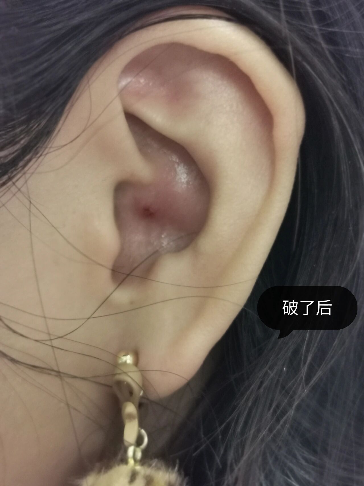 耳廓囊肿/肿块 不痛不痒不影响听力 过年回老家耳朵里突然长了硬痘痘