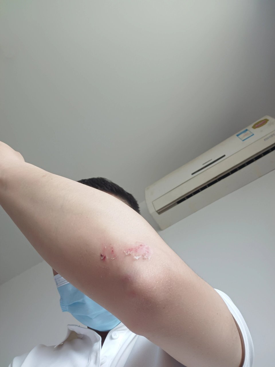 胳膊摔肿几天能好?