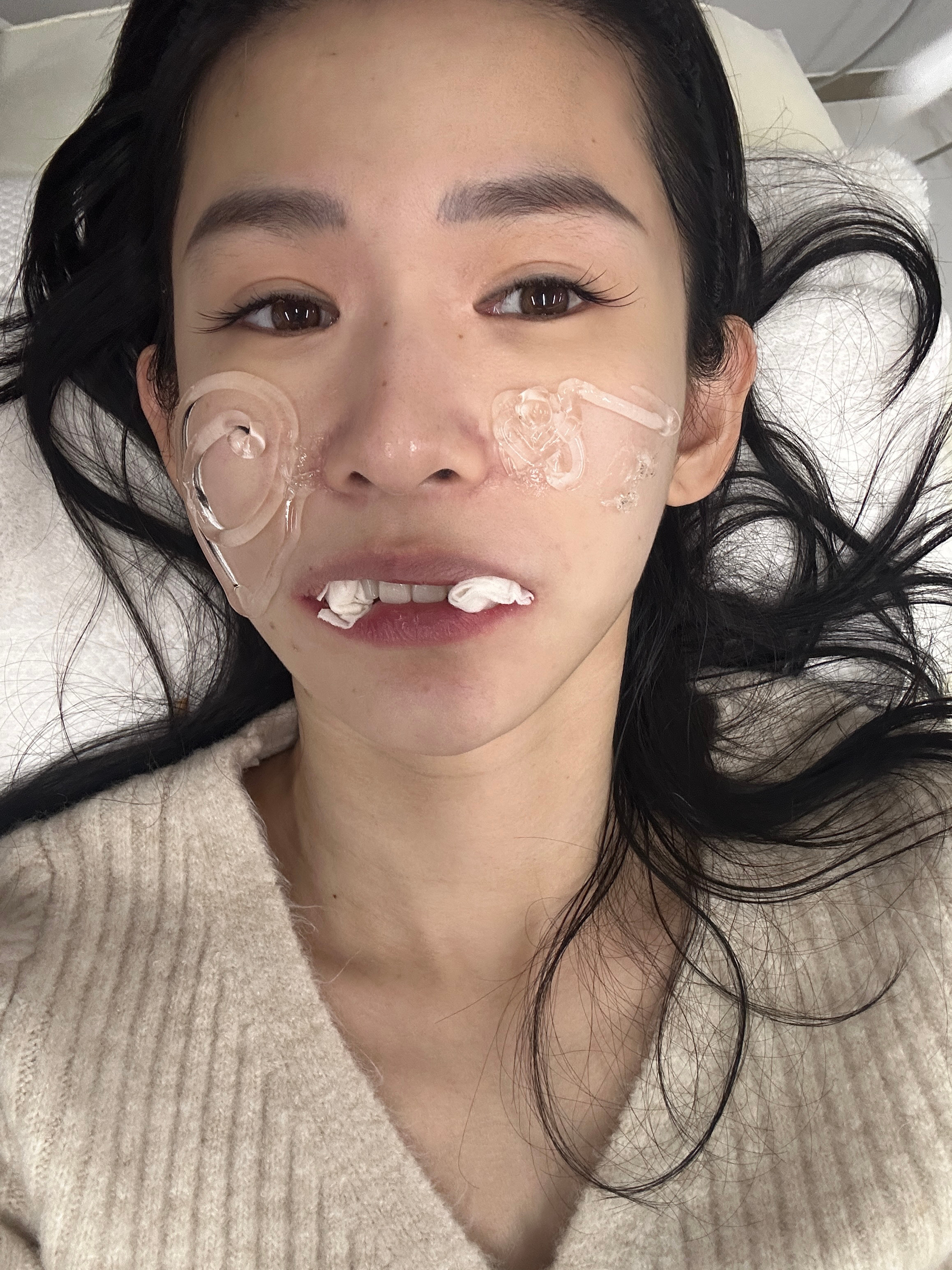 昨天打了台版超声刀加光子 超声刀靠近牙床这里真的痛到我发癫儿 做完