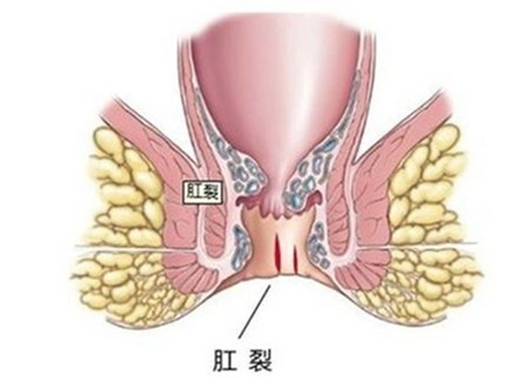 肛裂 毁三观图片