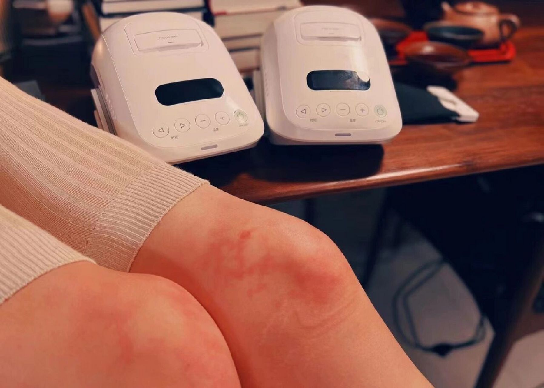 艾灸完的灸花 艾灸完,发现皮肤上有红纹一样的灸花,是好事,这是我们体