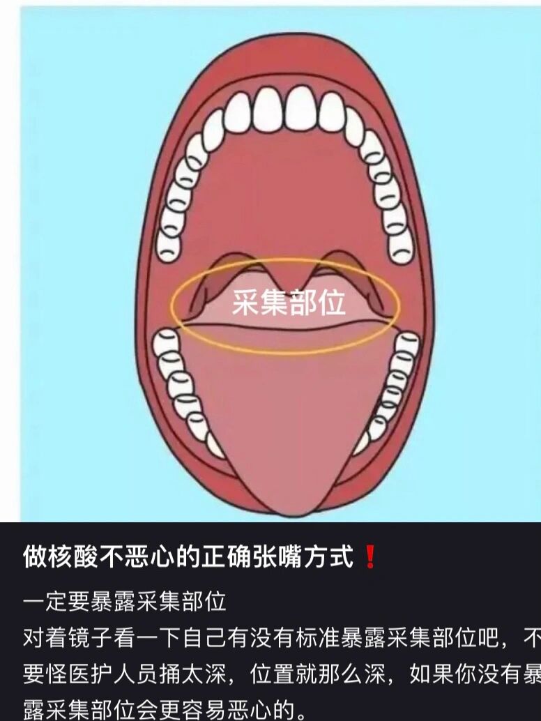 采核酸咽喉部准确部位图片