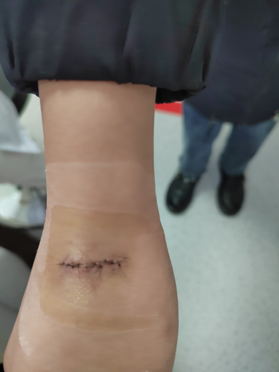 手术切除蓝痣后的刀口#色素痣