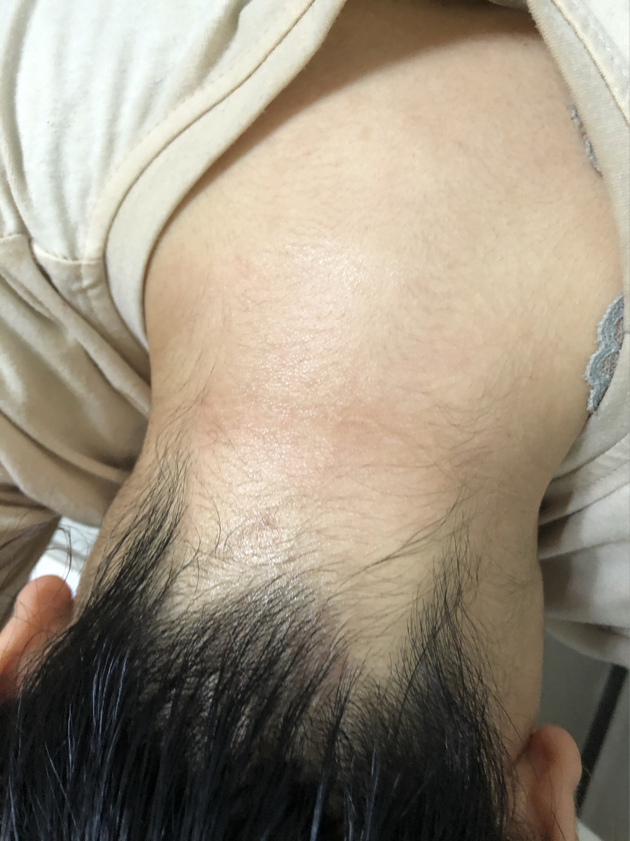 怎么治疗黑棘皮病 我是去年年初发现自己脖子上面有这样的一圈黑黑的