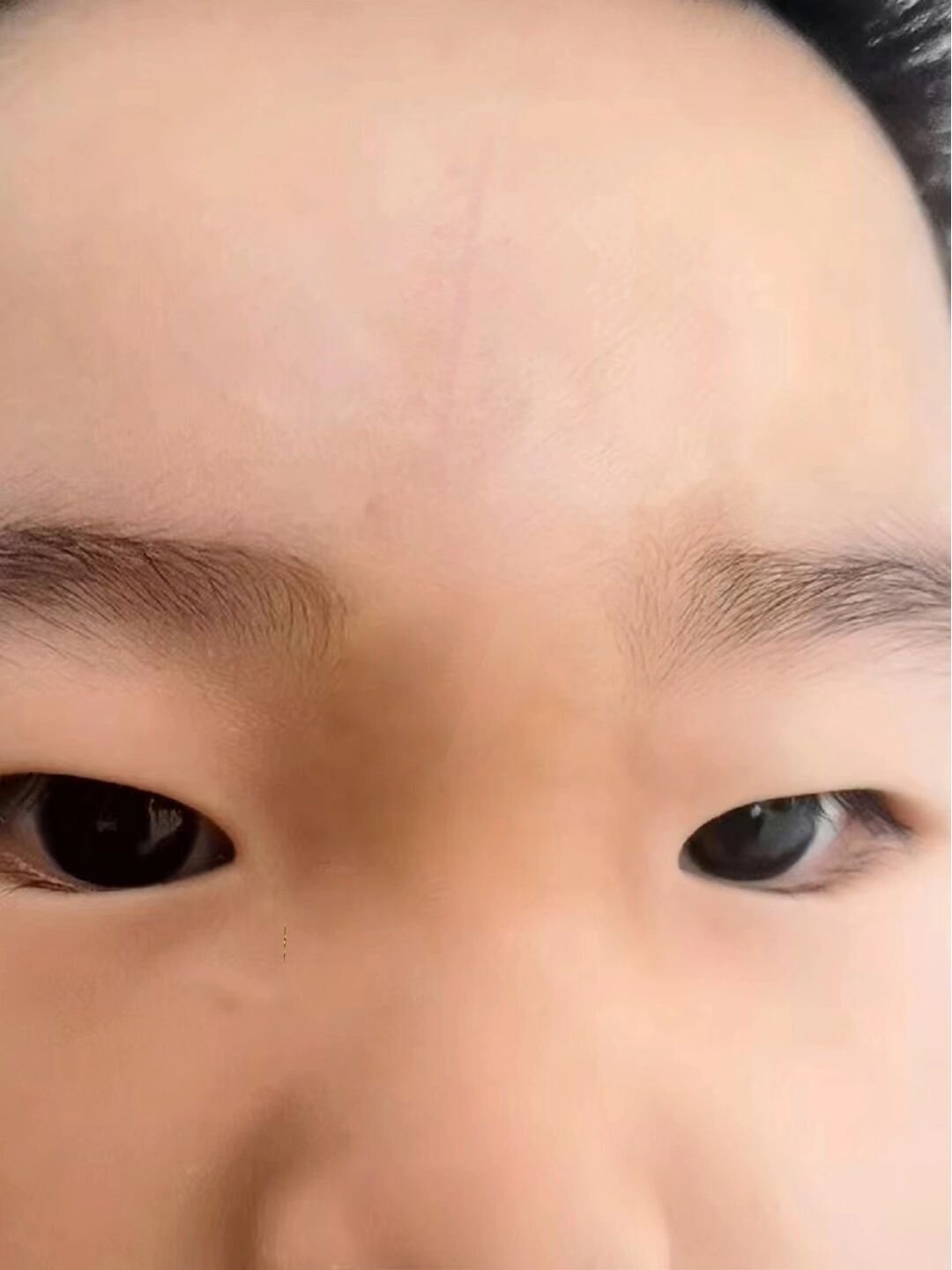 去了🏥做了缝合小孩额头缝针没留疤图