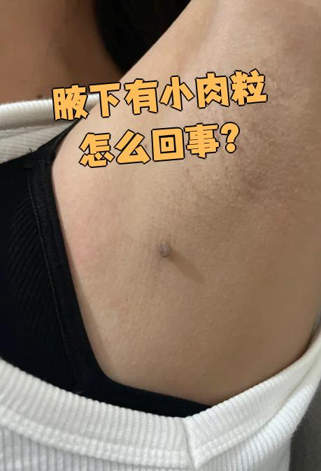 腋下长小肉粒最常见的原因是皮脂腺囊肿和丝状疣,需要先检查确诊再