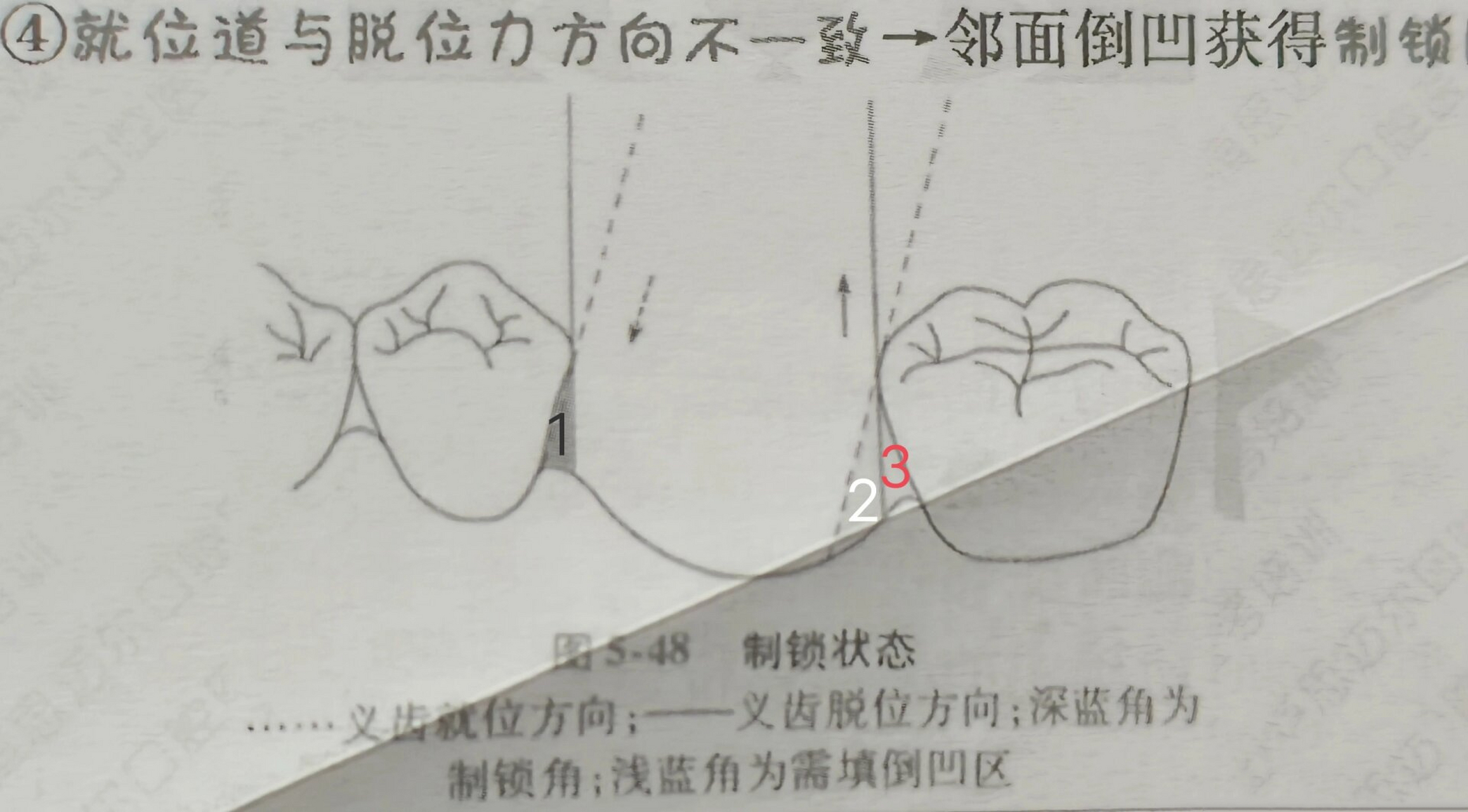 调凹法,制锁加强固位.