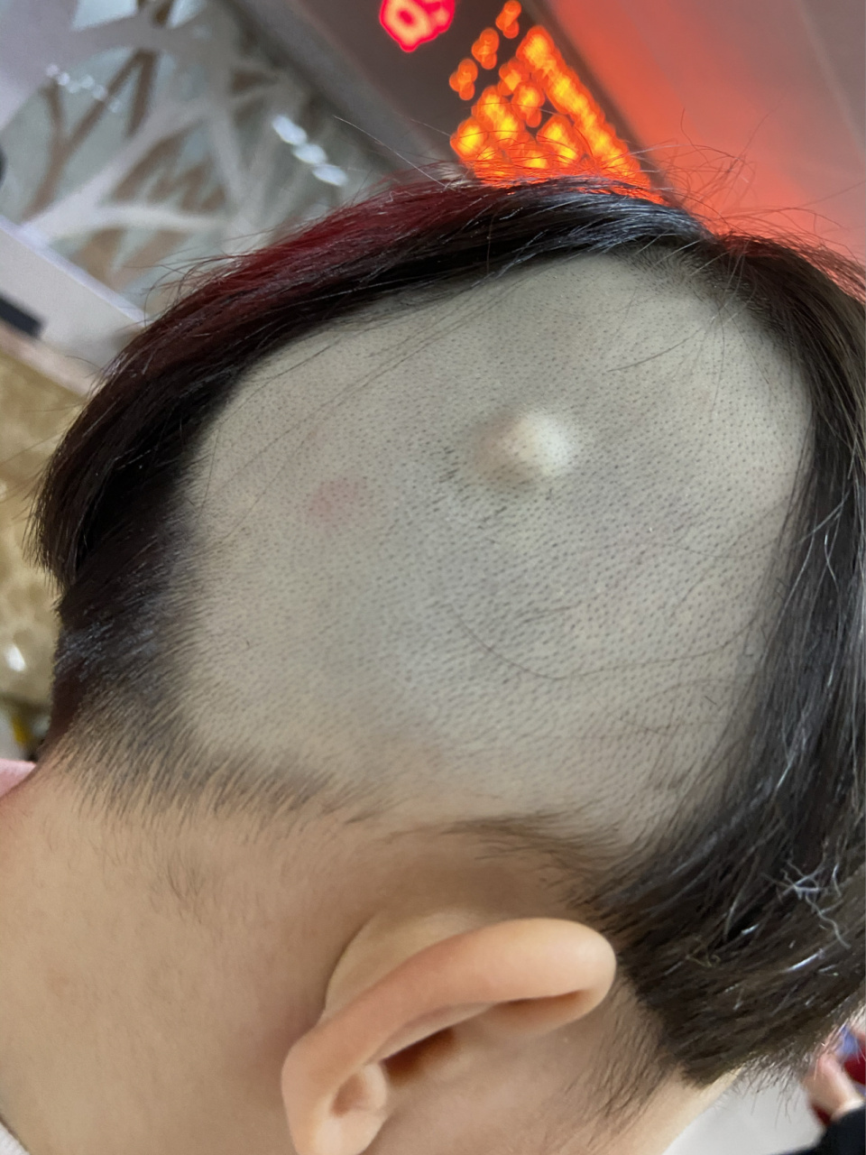 出生头上长了一个疙瘩,医生称为皮下囊肿 宝宝出生的时候发现头上长了