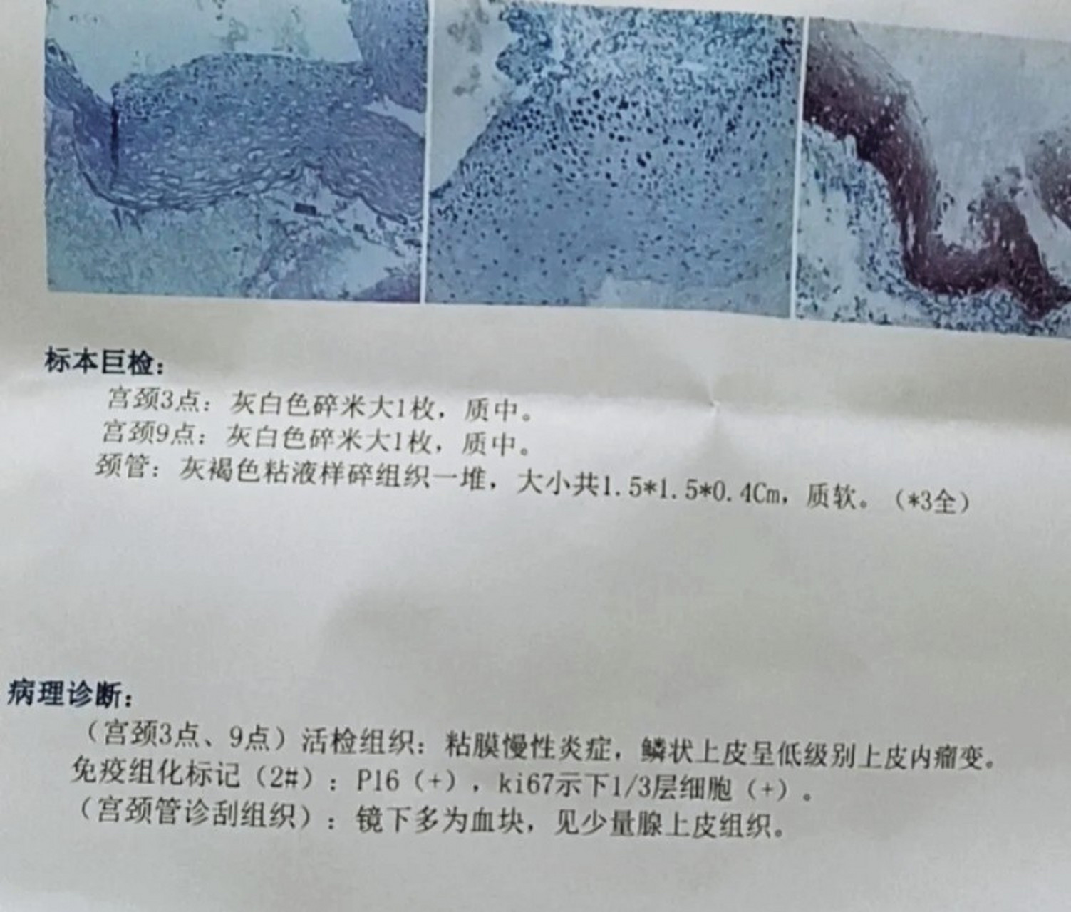 大家知道,活检的目的是取病理,取了病理后需要在显微镜下看细胞