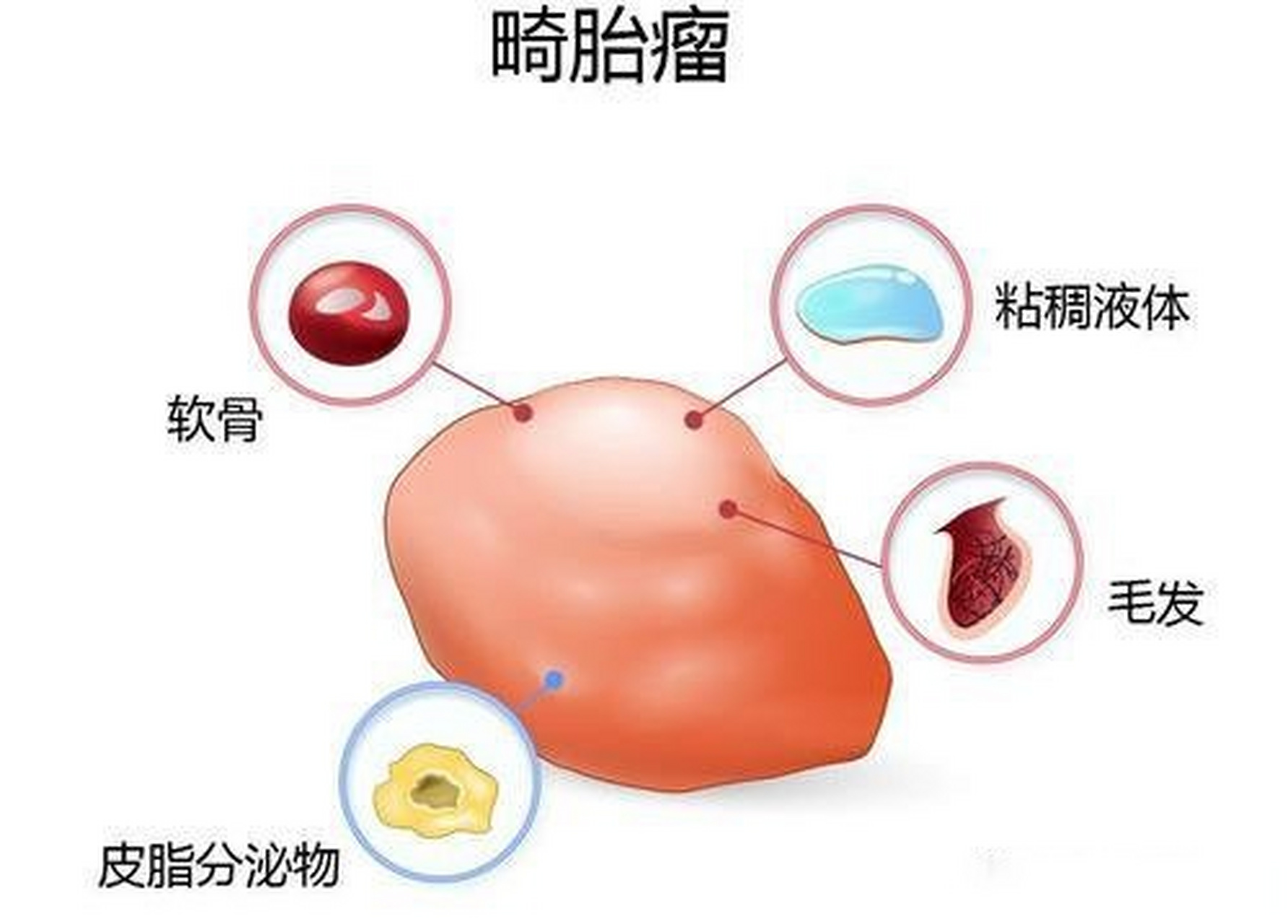 柚子状赘生物图片