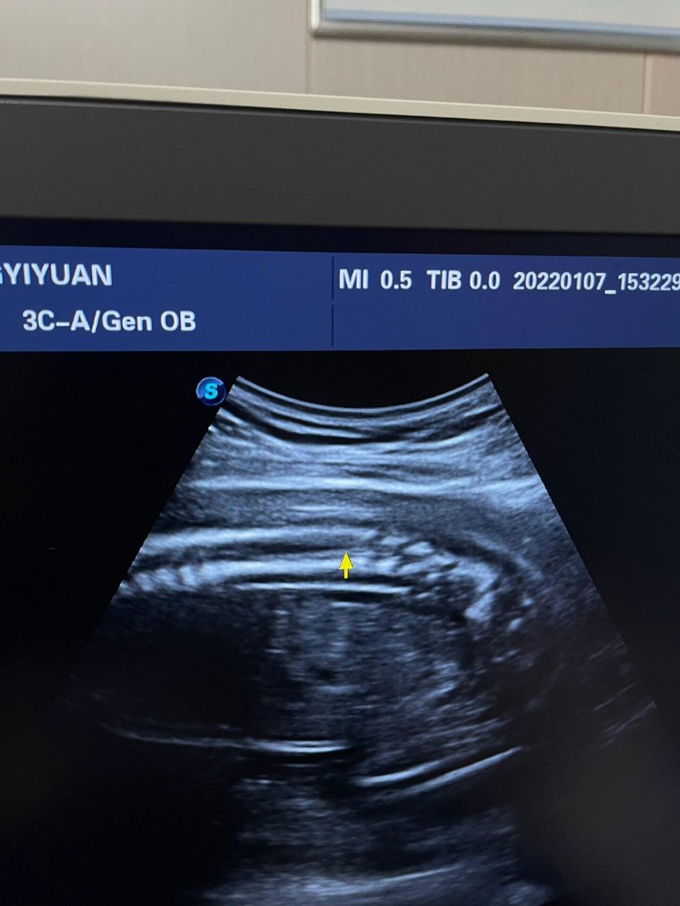 超声胎儿脊髓圆锥 脊髓圆锥声像图有两个特点——黑尖白细 ●黑尖