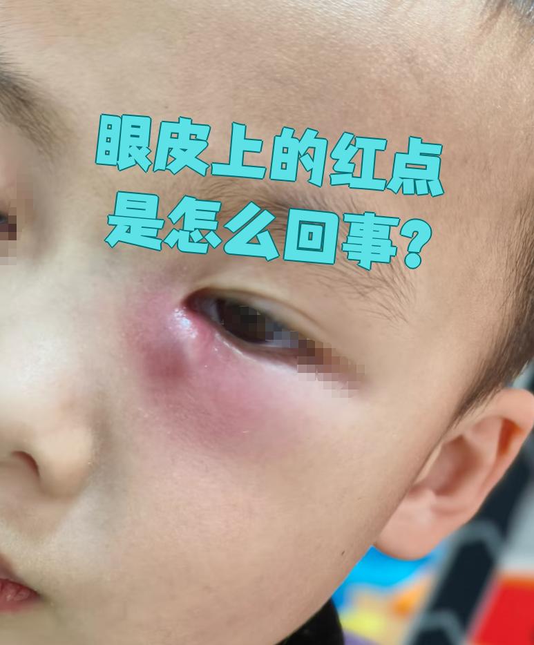 眼皮出现红点可能和蚊虫叮咬,眼睑炎,过敏性结膜炎有关