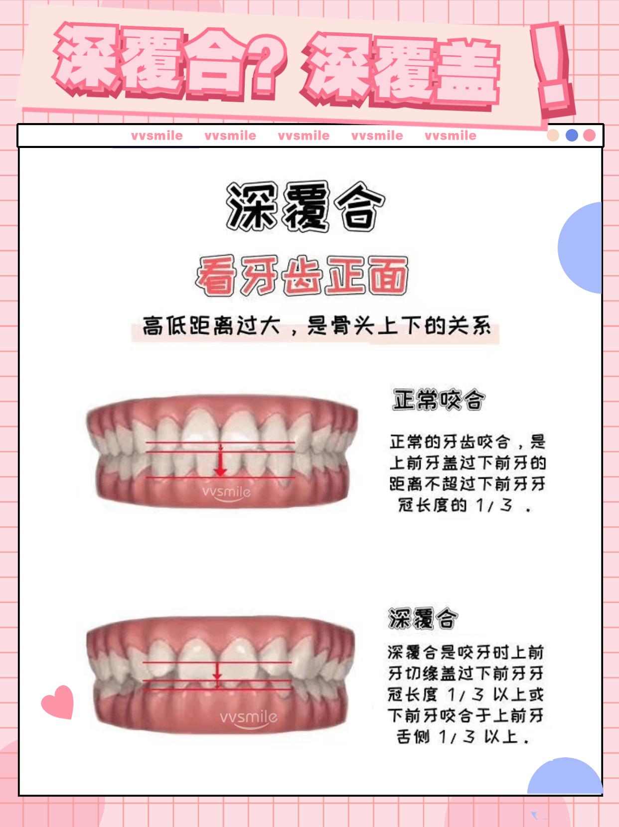 深覆合就是深覆盖那么它们俩究竟有什么区别