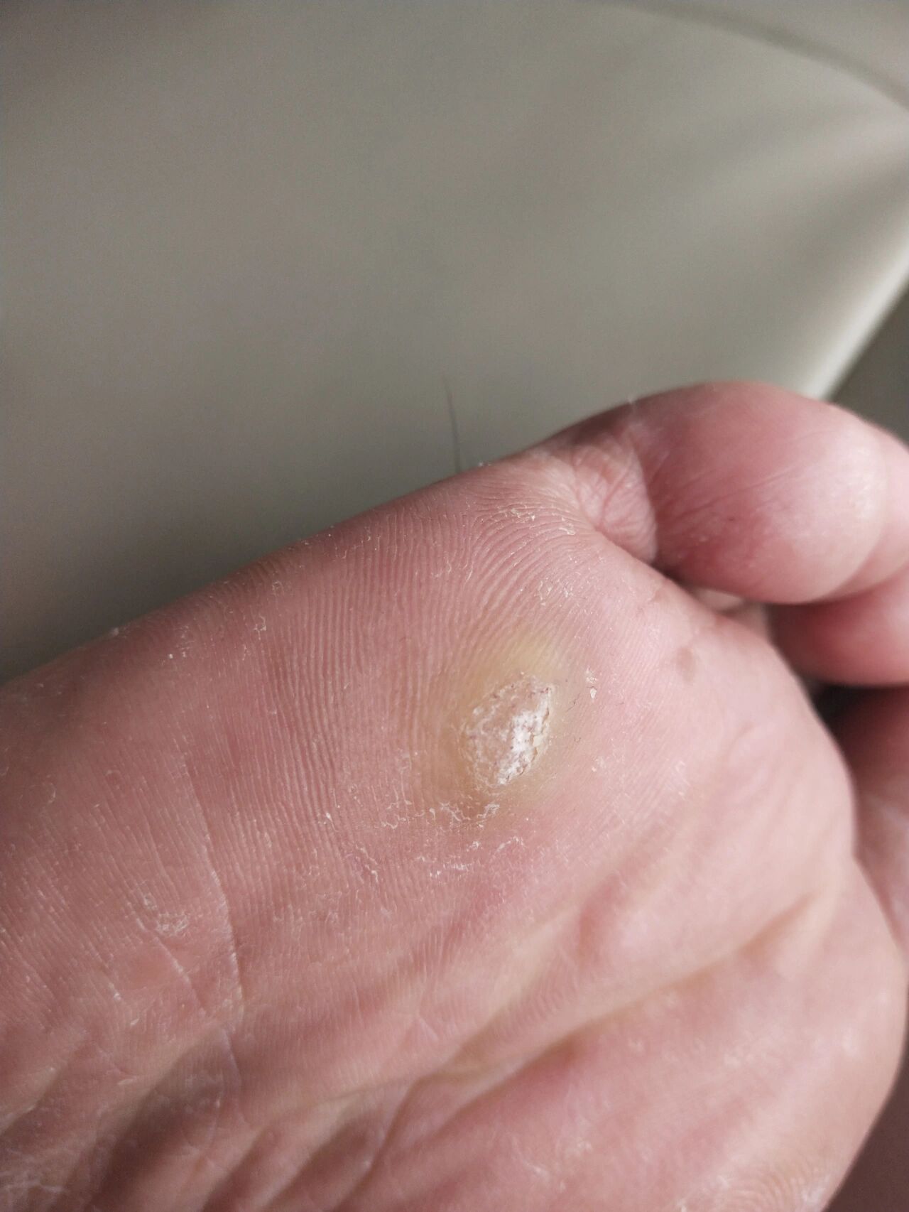 跖疣冷冻第一天 七月份就有的跖疣,中间自己简单修理了两次,一直不