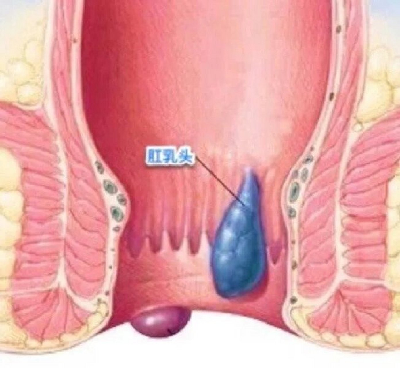 肛管减压图片