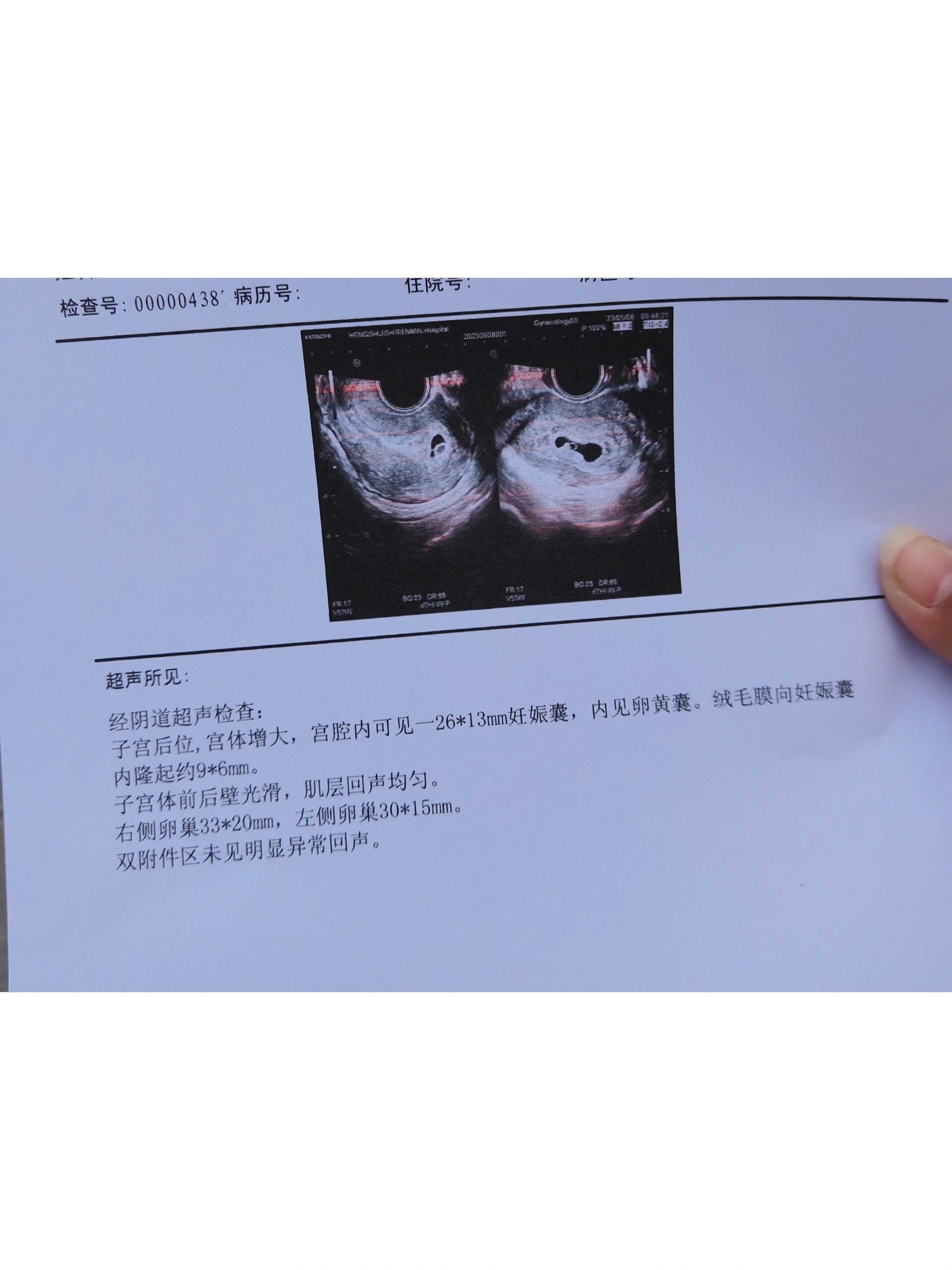 孕6周 能看到卵黄囊了