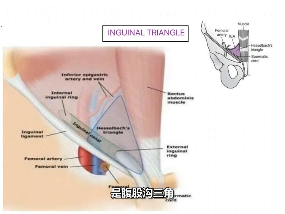 腹股沟三角hesselbach三角