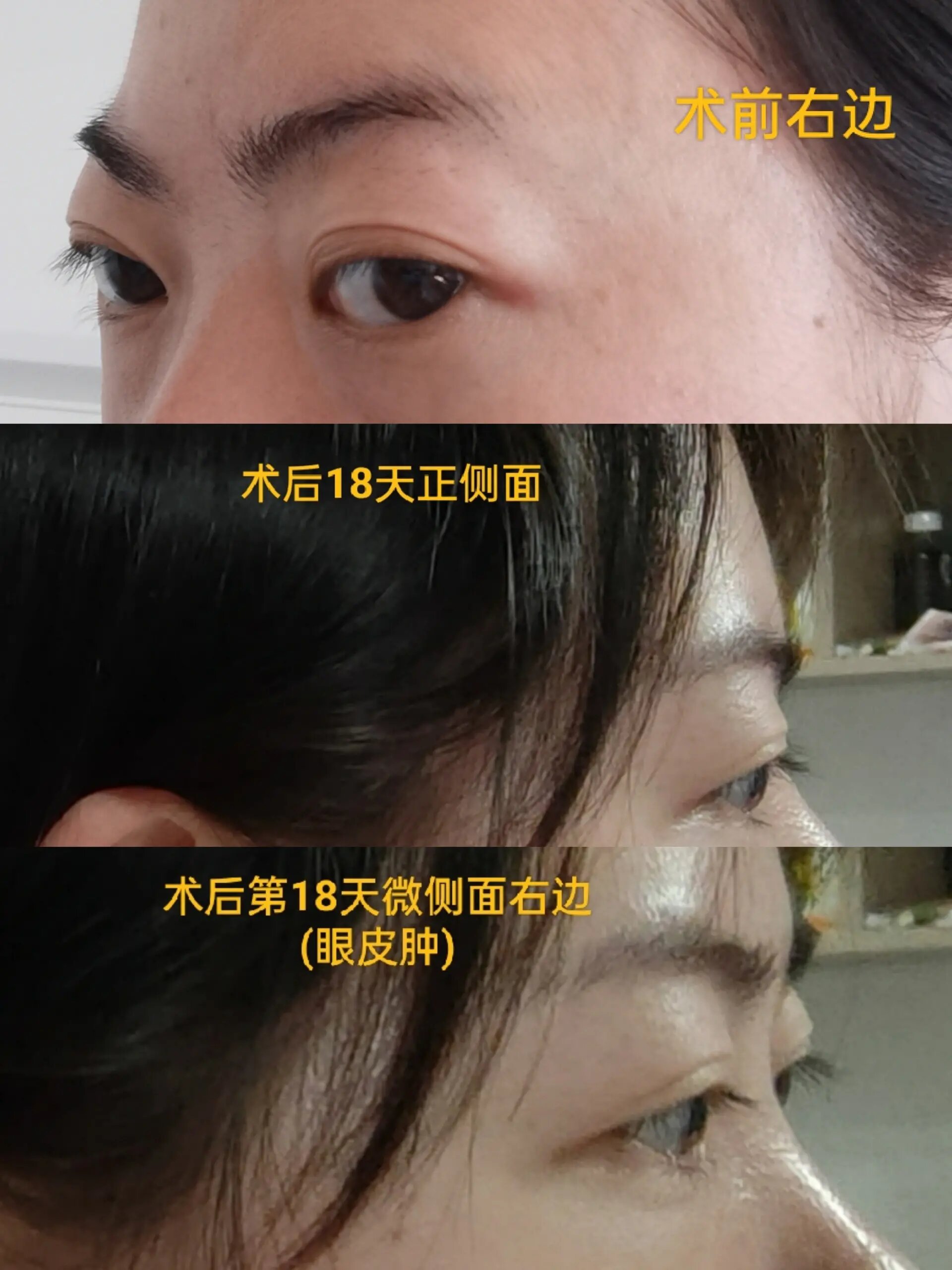 眼眶减压(突眼矫正)成功上岸第18天 眶减压第18天,眼部持续消肿,犹如