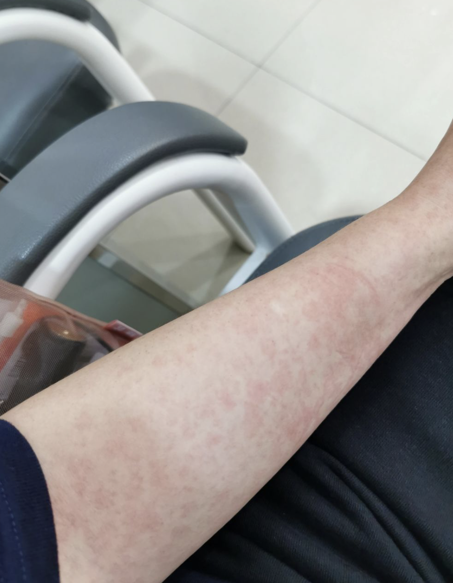 荨麻疹如果症状比较轻,忍住不抓挠,确实有可能自己好