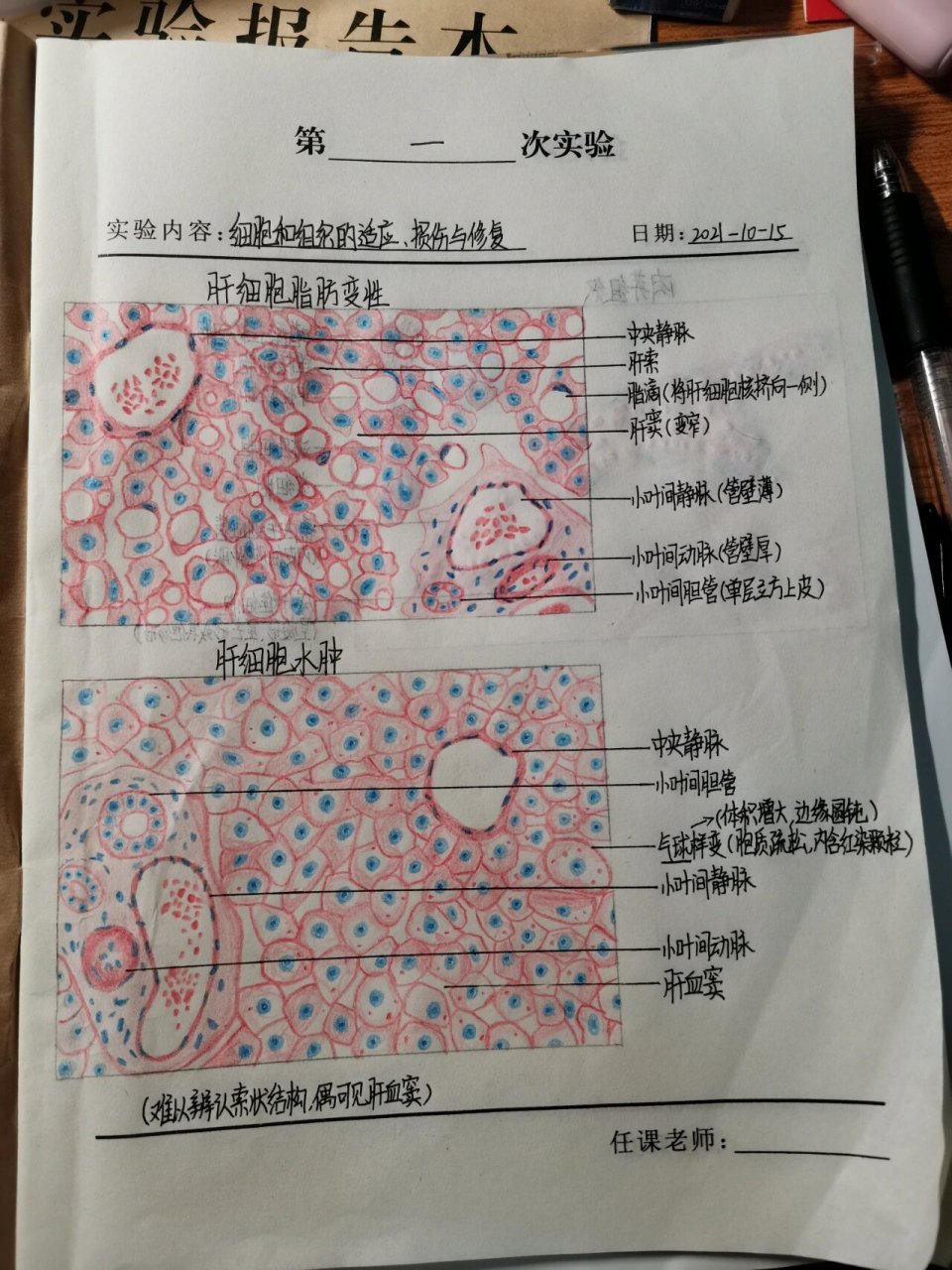 病理红蓝铅笔手绘图——细胞的损伤修复 99肝细胞脂肪变性 99肝