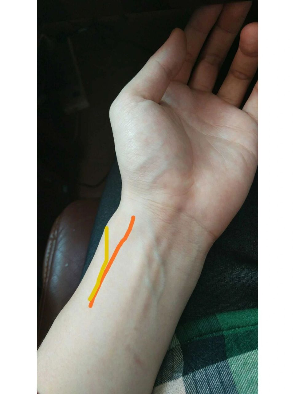 形成反关脉的原因你很难想到 反关脉并不是天生的,只有后天才能形成