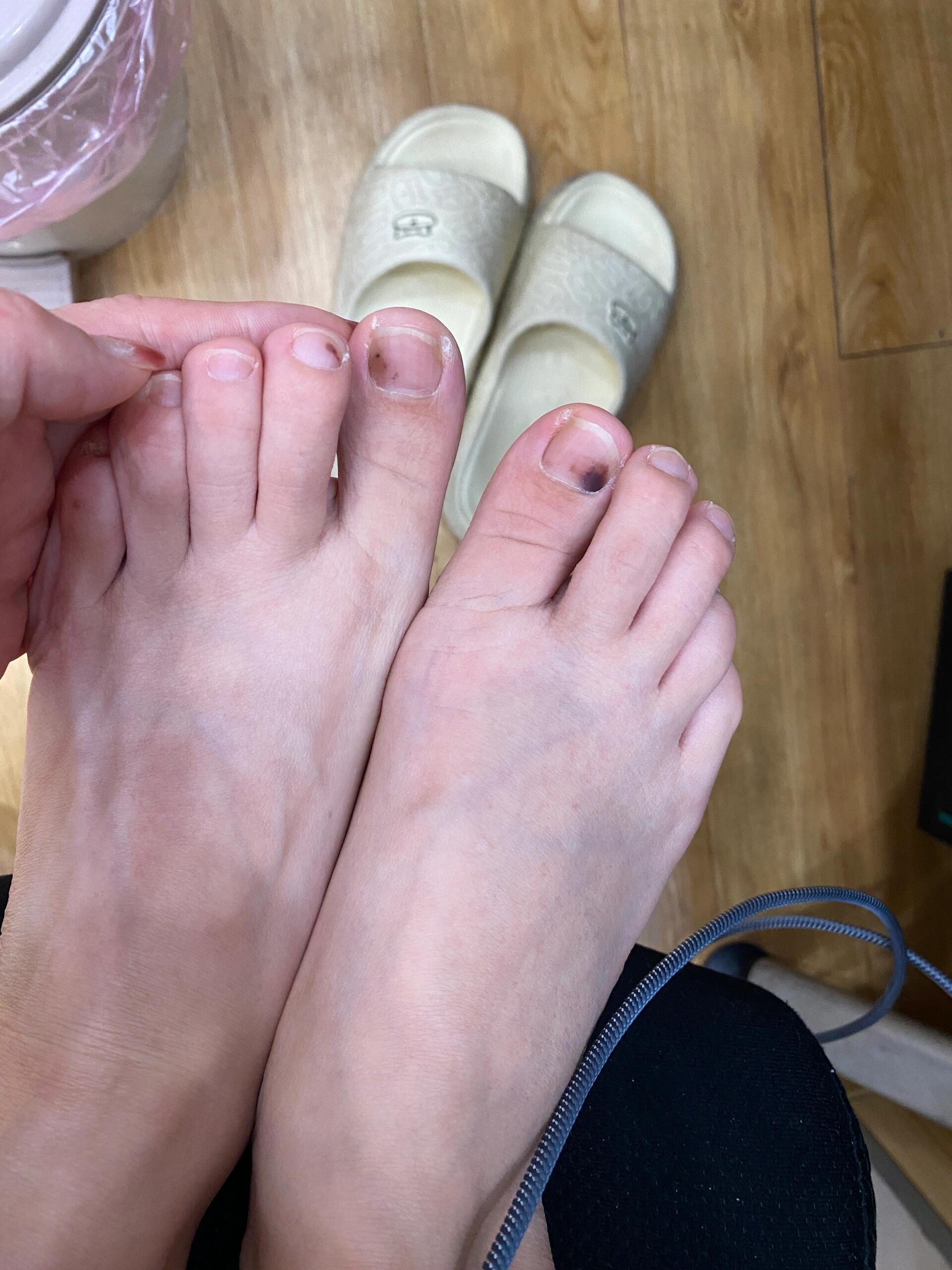 哪个知道脚丫子是怎么回事 紫黑色的 脚指甲盖出现紫黑色的情况 好久