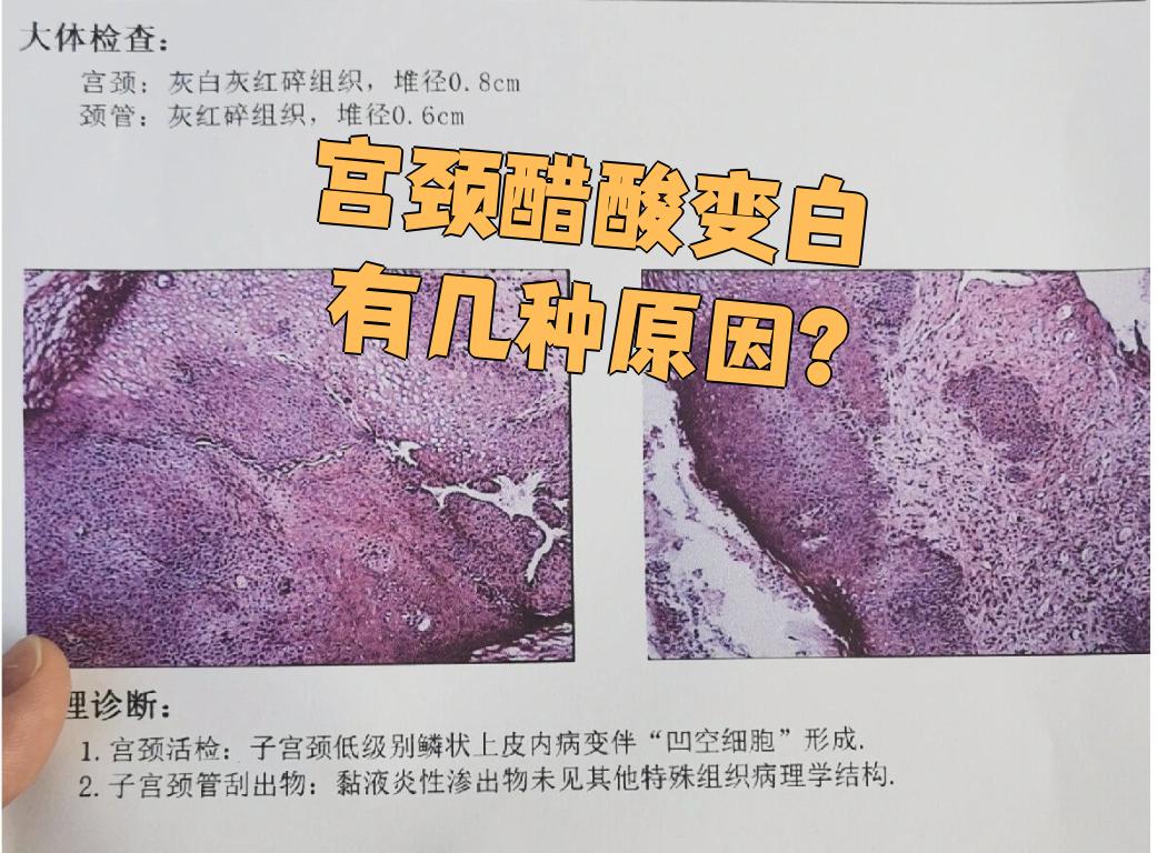 宫颈醋酸变白的原因有好几种,可能是正常的,也可能是宫颈炎,宫颈上