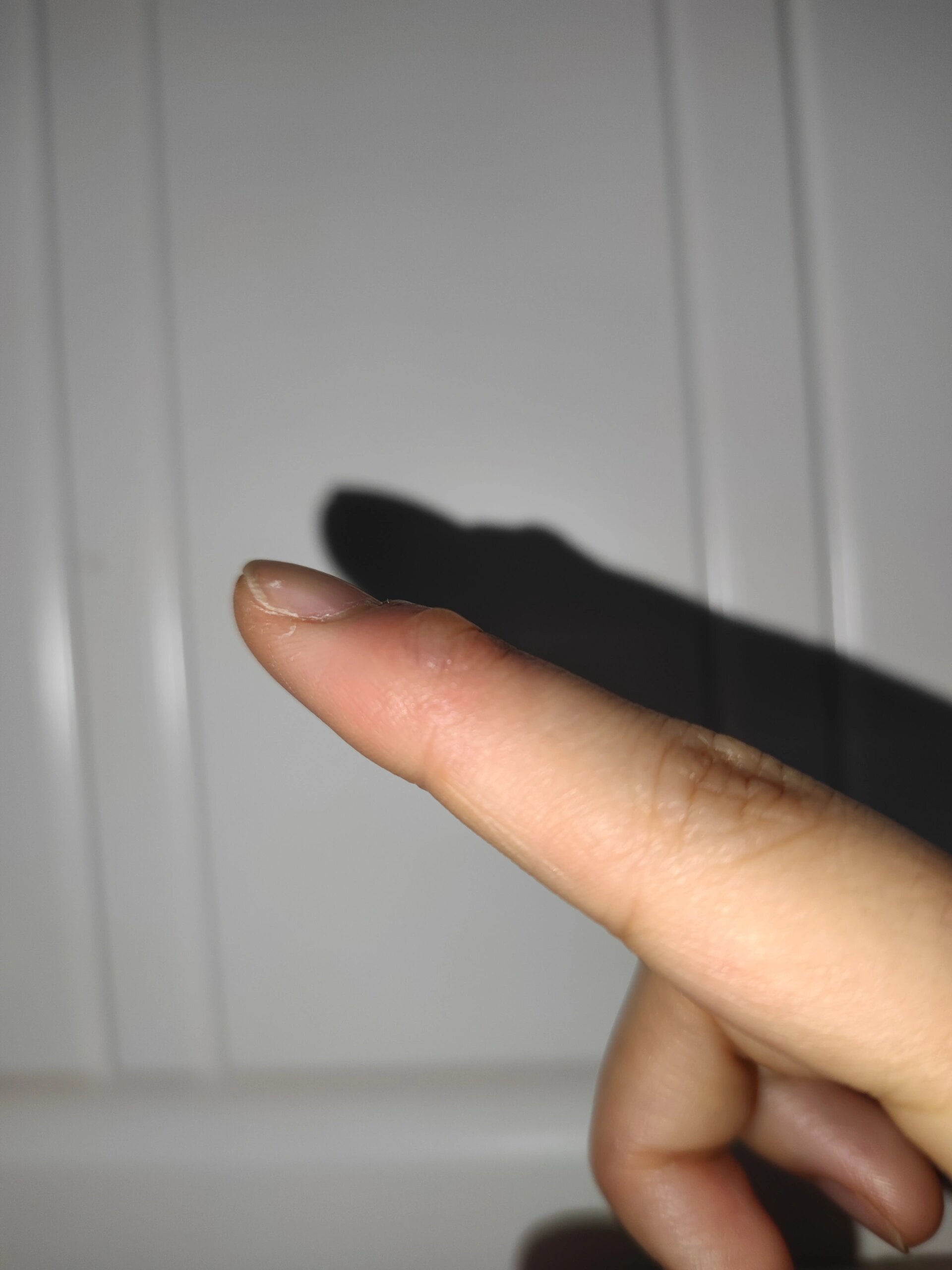 手指上突然长出一大颗水泡 前几天食指上突然变得很热很红,有点肿胀