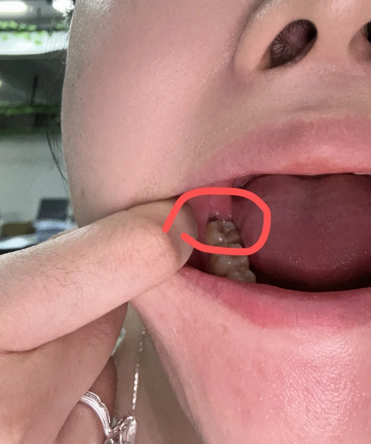 女生开始长智齿说明身体发育基本成熟了,这属于正常现象,没有特别的