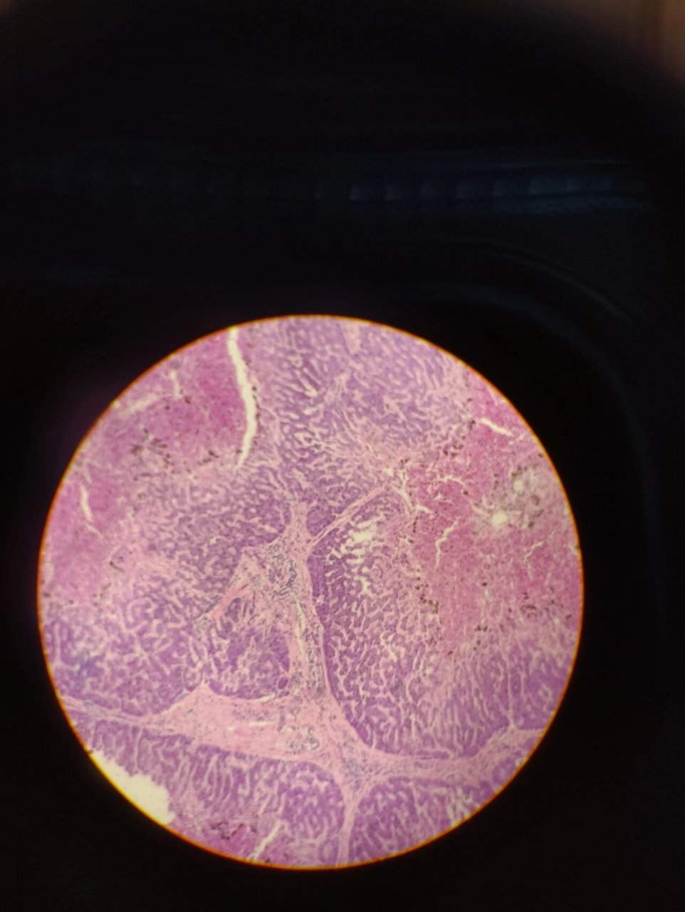镜下观 p1肉芽组织 p2混合血栓 p3混合血栓显微镜下观 p4