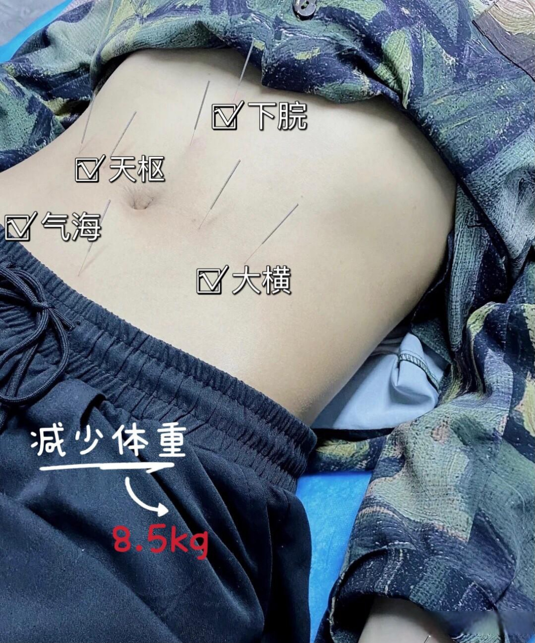 小女生昨天来做针灸减肥的最后一疗程治疗,顺手记录一下!