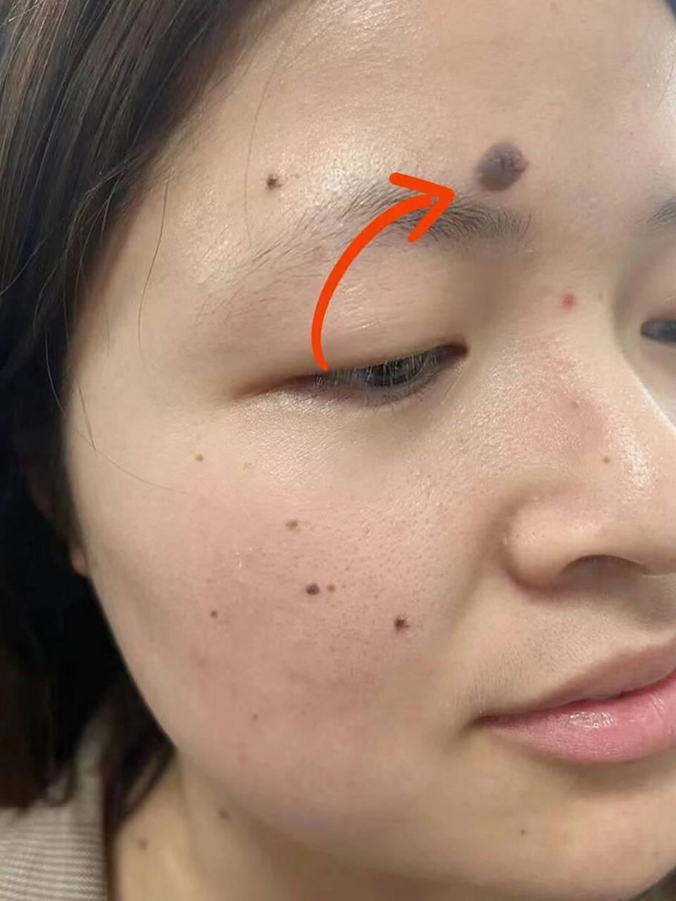 记录:因为脸上痣太多去三甲挂科被骂(社死) 现在想起来还是感觉有点