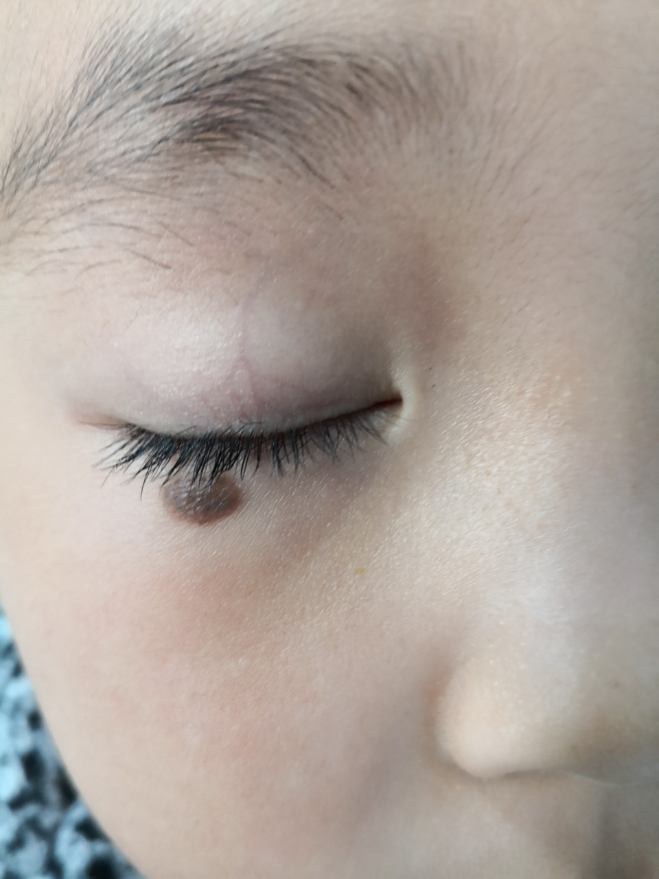 眼下方的色素痣.手术切除治疗.#美容##色素痣