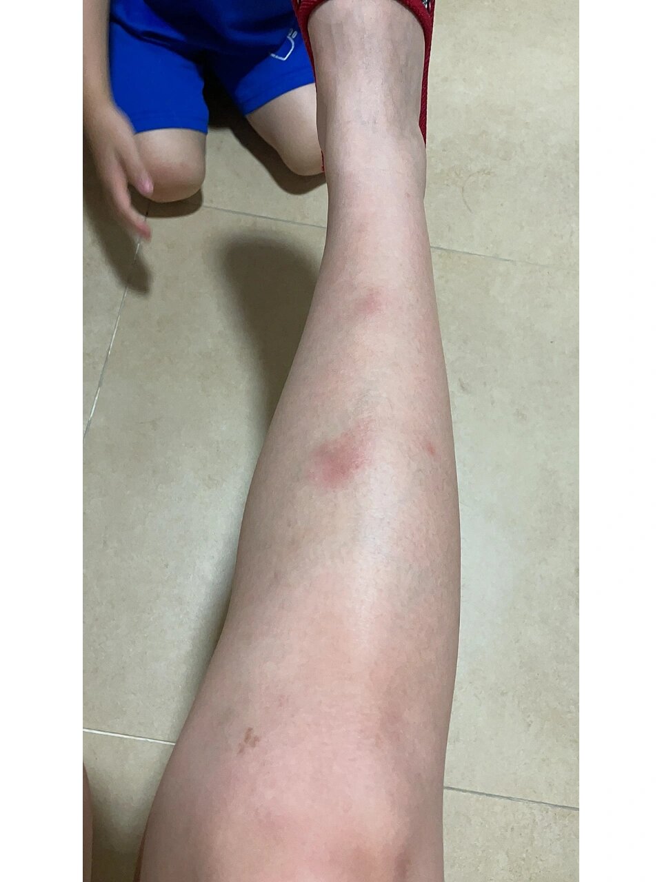 结节性红斑