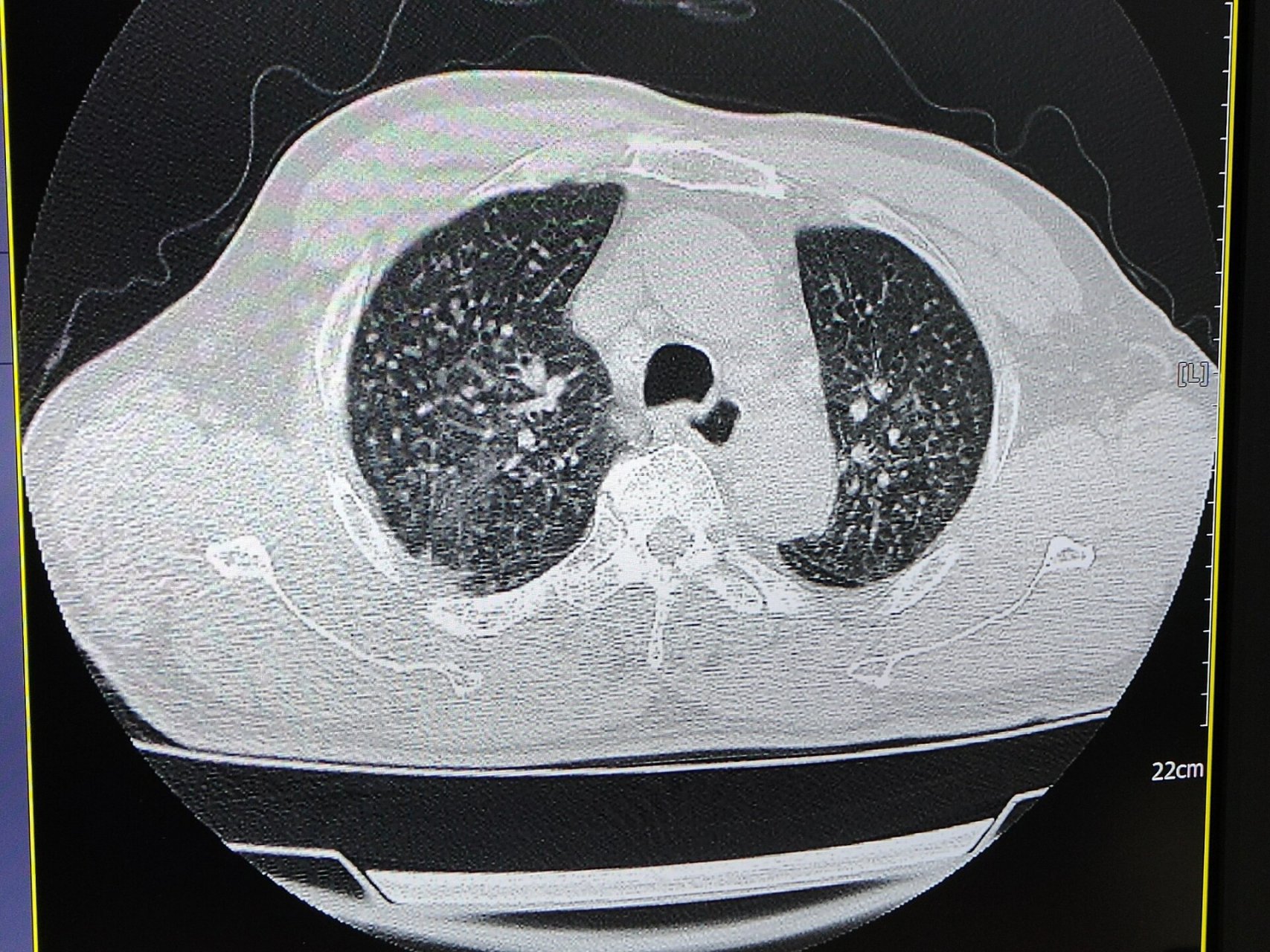 矽肺ct表现 两肺见弥漫多发粟粒结节影,可以看到两肺门,纵隔淋巴结轻