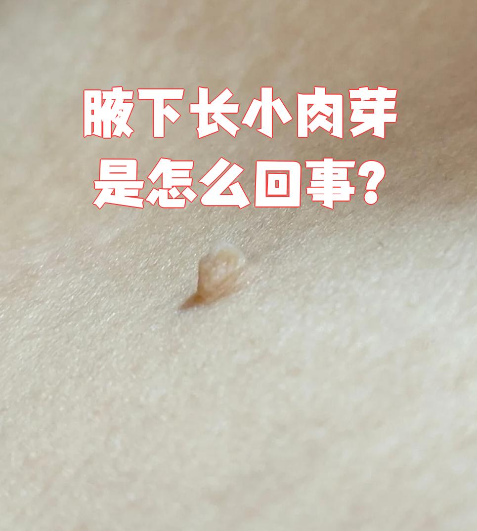 纤维瘤多见于中老年人,表现为黑色的小肉芽,通常不疼不痒,但摩擦时