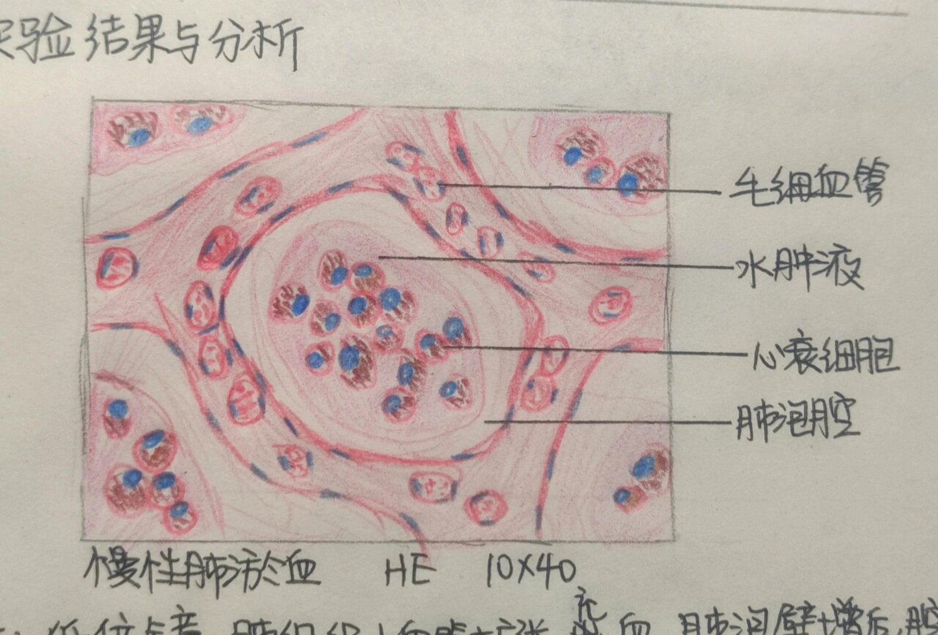 病理满分实验报告-慢性肺淤血 局部血液循环障碍 红蓝铅笔手绘 重点