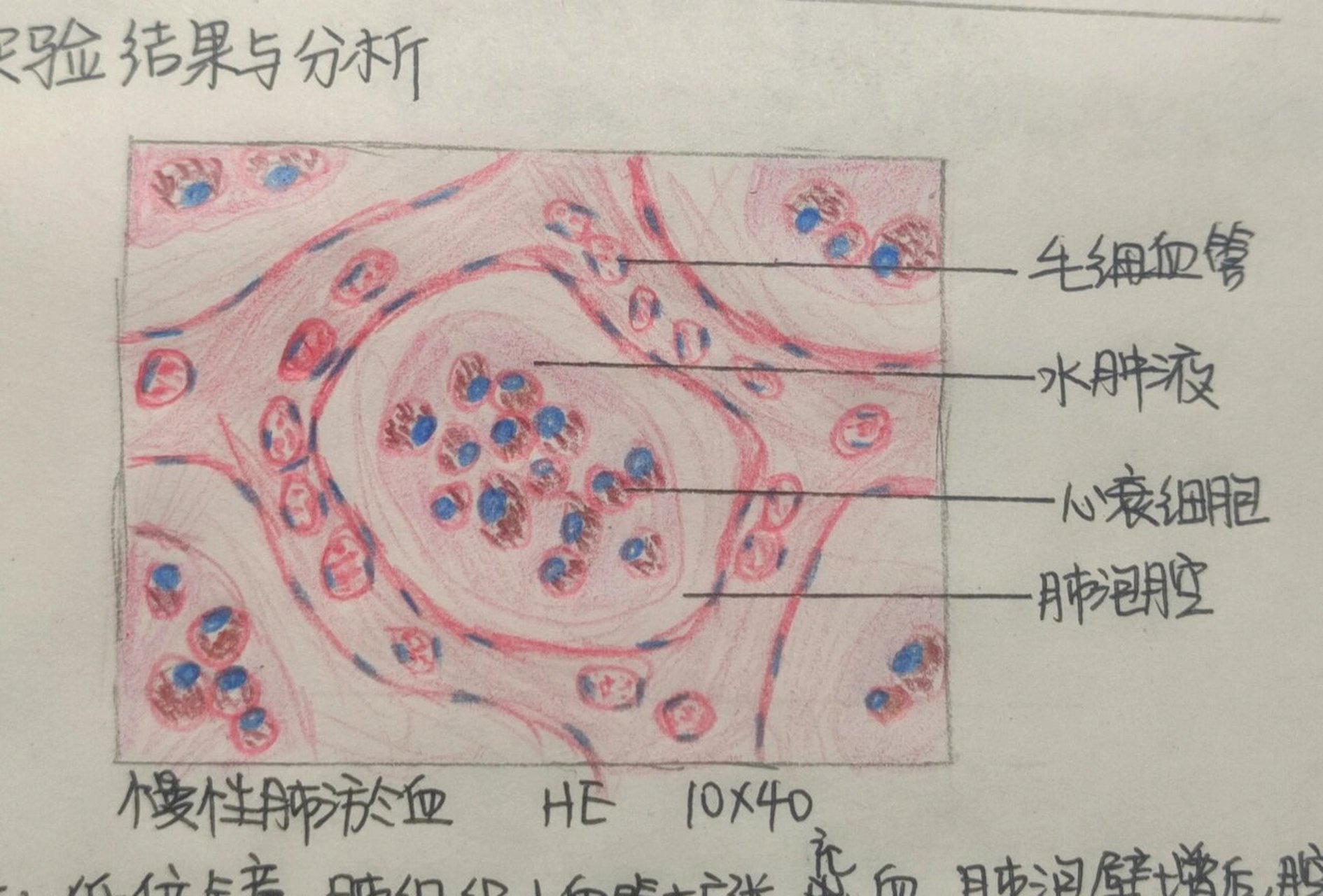 急性肺淤血红蓝手绘图图片