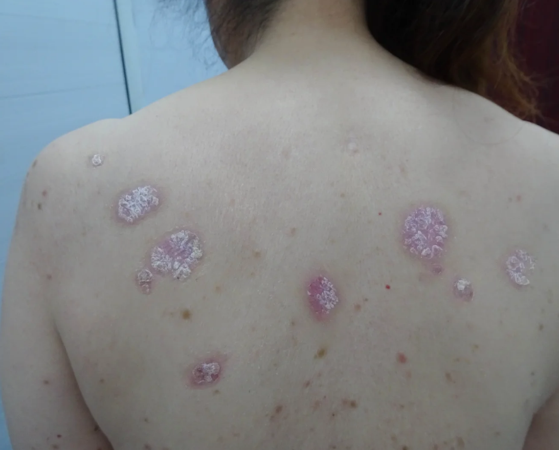 典型的银屑病症状是红色斑块上覆盖着银白色