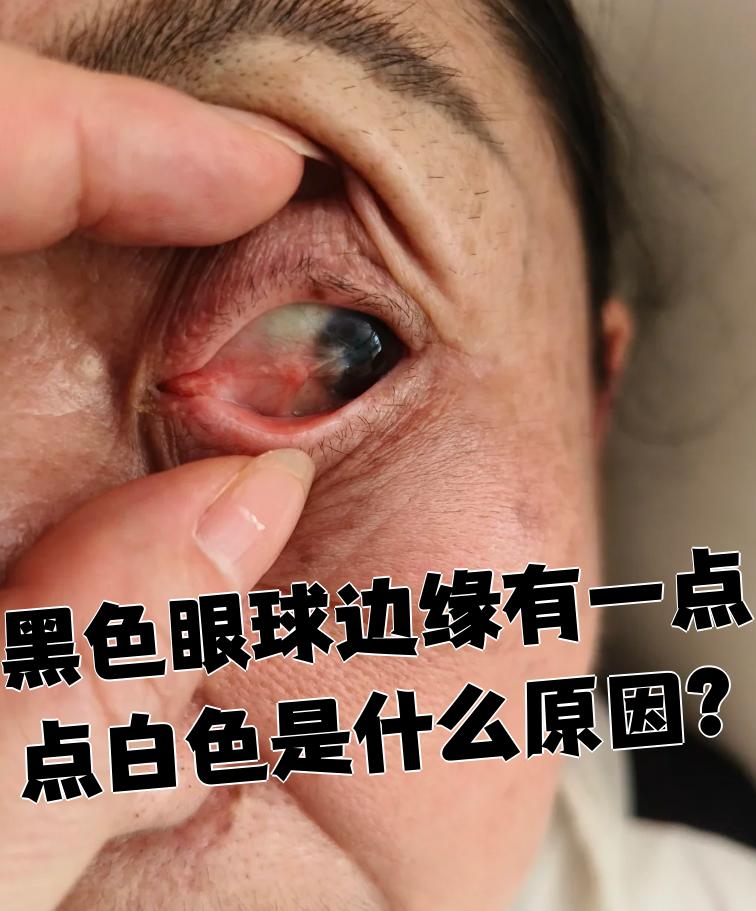 黑色眼球边缘出现白色可能是这些情况: