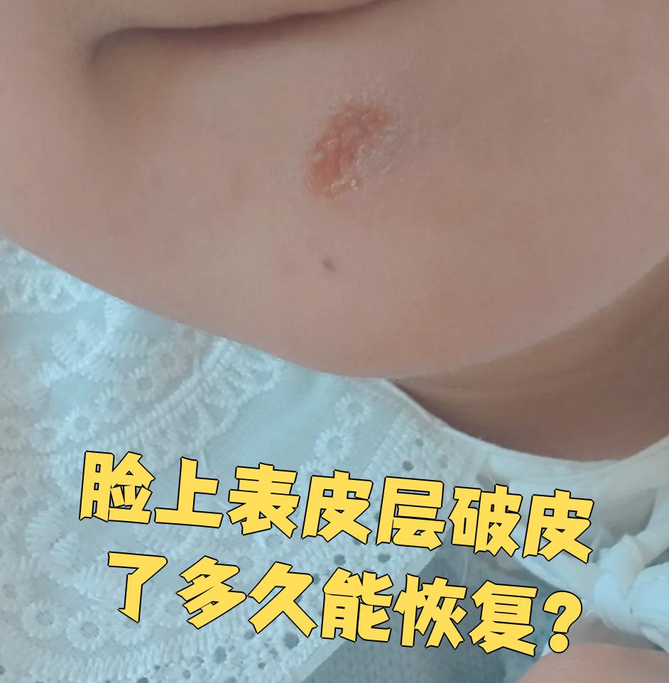 具体要看擦伤的严重程度,伤口大小和个人体质