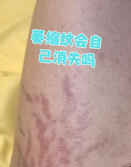 刚开始萎缩纹可能是淡红色的,时间久了颜色会变淡,但不会完全消退